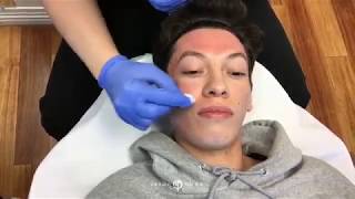 DEEP PHENOL TCA REVEPEEL CHEMICAL PEELING HELPS IMPROVE ACNE SCARS AND PORES  DR JASON EMER [upl. by Eerak269]