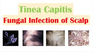 Fungal Infection of the Scalp Tinea Capitis  Causes Risk Factors Symptoms Diagnosis Treatment [upl. by Ahsiemal]