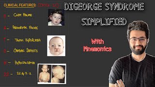 Digeorge Syndrome  Etiopathogenesis Clinical FeaturesDiagnosis and Management [upl. by Anod109]