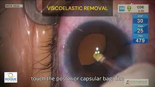 Viscoelastic removal [upl. by Curt]