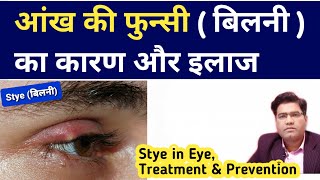 What is Stye its Cause Symptoms and Treatment [upl. by Baptista447]