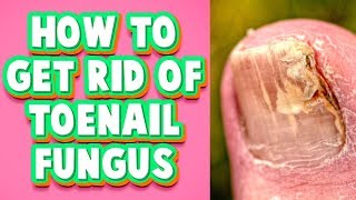 Toenail Fungus Treatment at Home A Fast Cure You Must Try [upl. by Brockie]