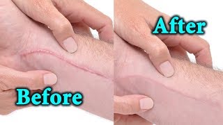 Keloid Scar Removal  Home Natural Remedies [upl. by Arved]