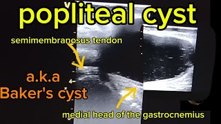 Popliteal Cysts Bakers Cysts Common Findings on Ultrasoundquot [upl. by Powel641]