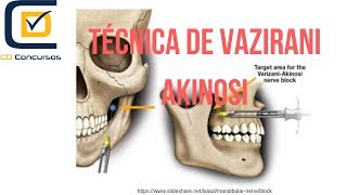 Técnica anestésica de VaziraniAkinosi [upl. by Kindig]