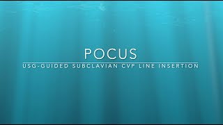 USG GUIDED Subclavian vein CVP Line insertion  infraclavicular approach long axis view  Part 1 [upl. by Edlyn]