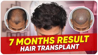 Hair Transplant Time Lapse  Step by Step Hair Transplant Surgery Time Lapse [upl. by Enirok]