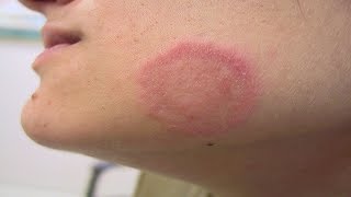 How To Get Rid Of Ringworm Fast At Home [upl. by Anailuig]