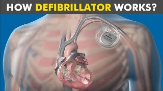 How Defibrillator Works Automated External Defibrillation working mechanism [upl. by Je]