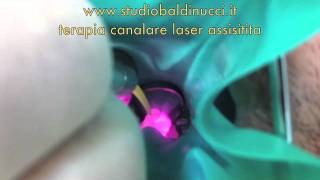 Terapia canalare laser assistitam4v [upl. by O'Rourke]