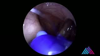 Eustachian tube balloon dilation for eustachian tube dysfunction [upl. by Bundy820]