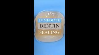 Immediate Dentin Sealing is necessary for biomimetic dentistry [upl. by Neffirg]