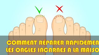 Comment réparer rapidement les ongles incarnés à la maison [upl. by Anum]