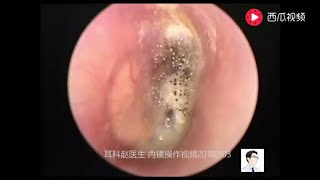 Earwax Removal ExtractionCerumen airtight 13 minutes [upl. by Lipfert]