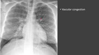 Pulmonary Edema [upl. by Paucker404]