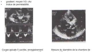 CARDIOLOGIE RÉTRÉCISSEMENT AORTIQUE [upl. by Neffets]