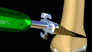 Distal Femoral Osteotomy to correct a valgus knee [upl. by Eri855]