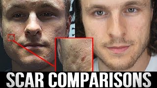 MY ACNE SCAR TREATMENT RESULTS TWO YEARS LATER  Realistic Expectations [upl. by Roley399]