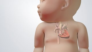 Blue Baby Heart Defect Tetralogy of Fallot Treatments [upl. by Devine]