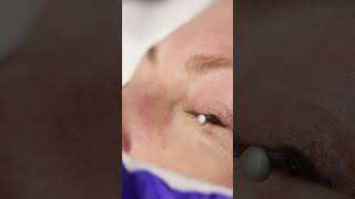 Eye Wrinkles Treatment with Ablative Co2 Laser [upl. by Garrity461]