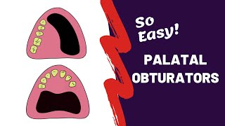 PROSTHODONTICS  What is Palatal Obturator [upl. by Lipinski452]