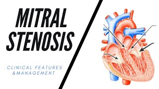 Mitral Stenosis  Clinical Features amp Management [upl. by Towland541]