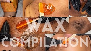 Waxing Marathon  Wax Compilation  Hirsutism  Leg  Underarm 20 MINUTES [upl. by Ravaj923]