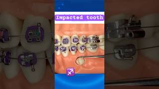 Impacted tooth during Braces [upl. by Brout699]