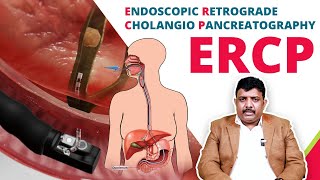 பித்தக்குழாய் என்டோஸ்கோப்பி  What is ERCP Procedure and How it is done  Dr John Grifson [upl. by Evslin]