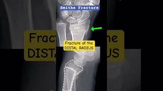 Wrist Fracture  Smiths fracture of the Distal Radius🩻🦴 shorts radiology doctor [upl. by Ztnarf]