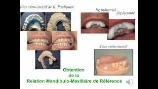 Relation Mandibulo Maxillaire Référence en Prothèse wmv [upl. by Asiulana]