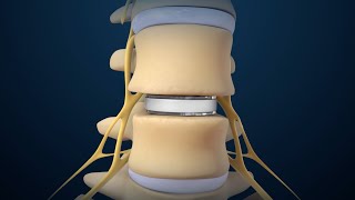 Back Surgery Lumbar Disc Replacement [upl. by Janaya846]