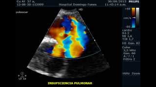 Ductus AV Dr Pedro Guillermo Bustos 14 Sep 2013 [upl. by Halet]