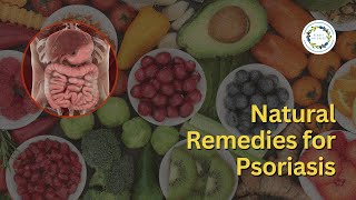 Natural Remedies For Psoriasis [upl. by Ibba]