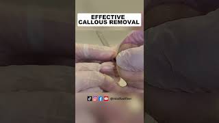 Effective Callous Removal For Keratoderma A Detailed Guide  Miss Foot Fixer [upl. by Akinit281]