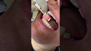 Crowning a tooth saving teeth” shorts dental dentaltreatment [upl. by Haroldson]