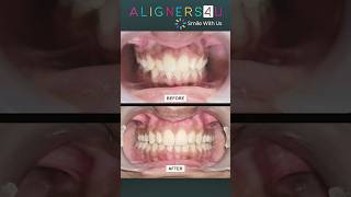 Smile Transformation Starts Here  Clear Aligners  Hyderabad  Invisible Braces  Aligners4u [upl. by Codd845]