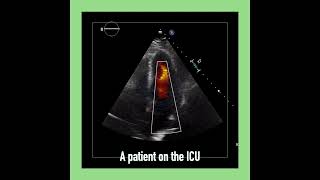 〖Echocardiography〗 The LVOT signal amp the ICU  fluid status 🏥 [upl. by Ahsatal]