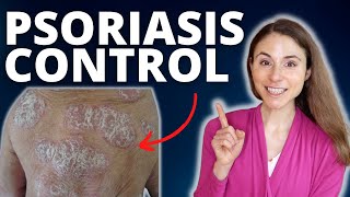 TOP 5 TIPS TO CONTROL PSORIASIS FLARES 😊 DERMATOLOGIST DrDrayzday [upl. by Alat450]