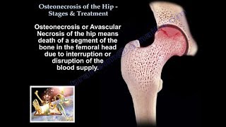 Osteonecrosis Of The Hip Stages amp Treatment  Everything You Need To Know  Dr Nabil [upl. by Aicnetroh]