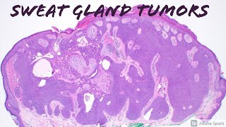 Sweat Gland Tumors  Solid Pink Pattern poroma hidradenomaacrospiroma amp family [upl. by Kerekes]