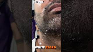 White Beard Removal Treatment By Fue Method  White Beard Permanent Solution  whitebeard fue [upl. by Japeth]