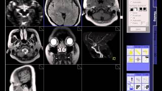 BRAIN MRI NORMAL [upl. by Ejroj]