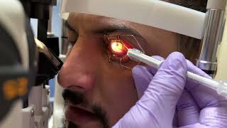 Removal of Metal Embedded in Cornea [upl. by Attiuqal]