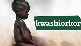 Kwashiorkor Disease What Causes Kwashiorkor जानिये क्वाशियोरकर रोग क्या है इसके लक्षण व उपाय [upl. by Giddings]