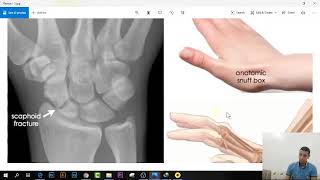 شرح كل كسور استقبال العظام فى ساعتين  16 Scaphoid Fracture [upl. by Ashla]