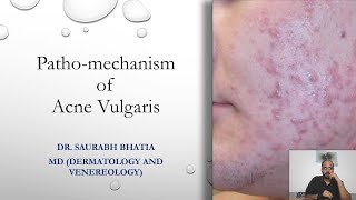 Pathomechanism of Acne Vulgaris [upl. by Annatsirhc]