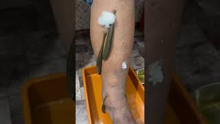 Can leeches remove blood clots leechtherapyswellingvaricoseveinspainskinskincarelegpaindr [upl. by Haidabej]