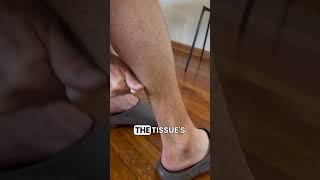 Scraping techniques for tight calves and shin splints runningrehab shinsplints calfpain runners [upl. by Eihctir]