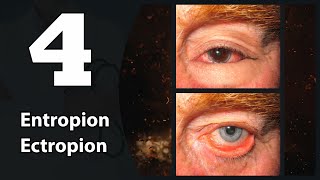 4 Eye lids Entropion amp Ectropion [upl. by Namajneb800]